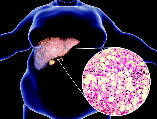 fatty liver (liver with fat cells)
