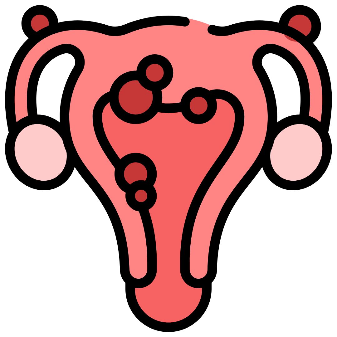 Icon showing fibroids or endometriosis affecting female fertility