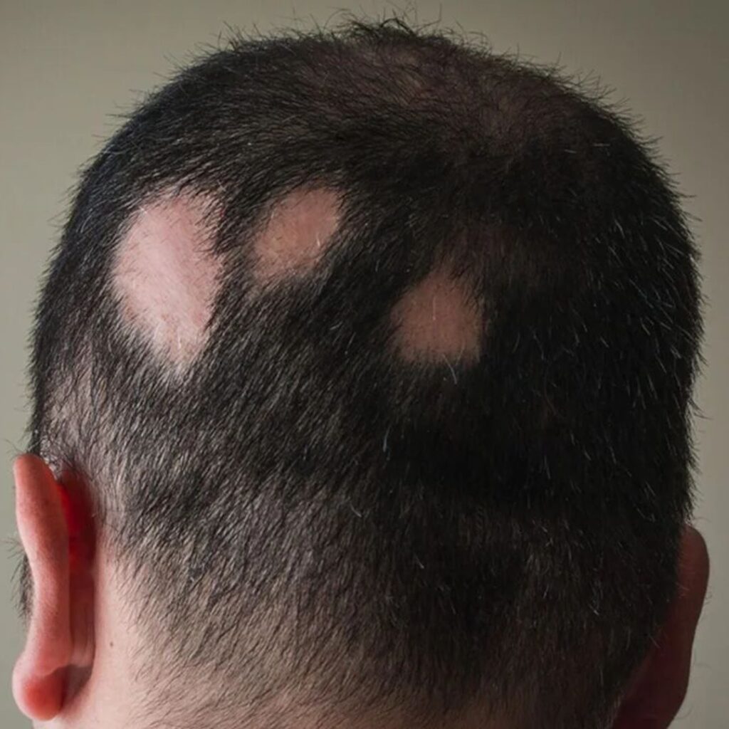 Alopecia areata patch on the scalp showing localized inflammation and poor circulation, a condition that may benefit from Panchakarma Raktamokshana therapies