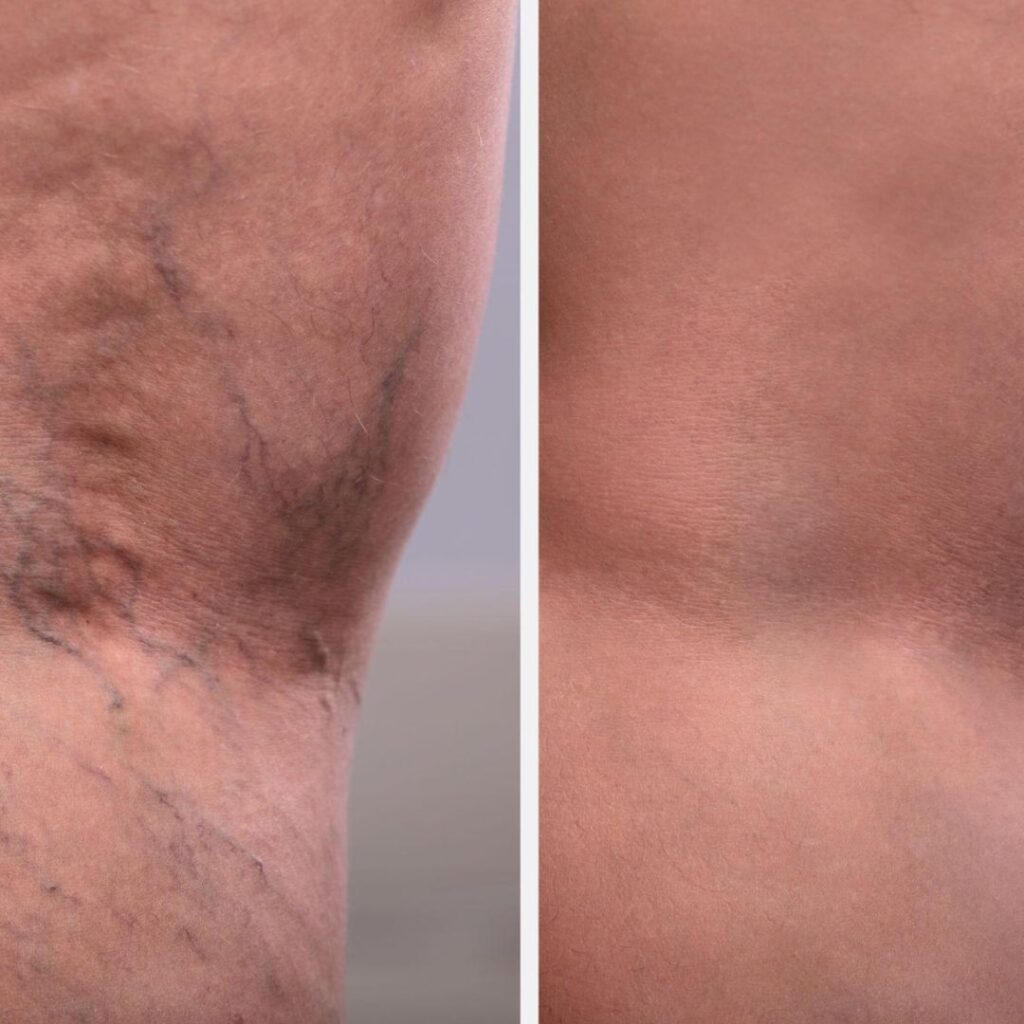 Improved varicose veins in the leg after Raktamokshana, showing reduced swelling and better blood flow from leech therapy benefits