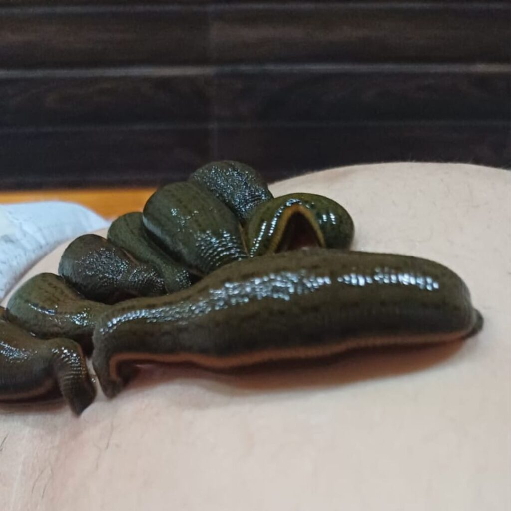 Leech Therapy in Ayurveda being applied on the lower abdominal area to support pelvic circulation and reduce inflammatory discomfort related to endometriosis
