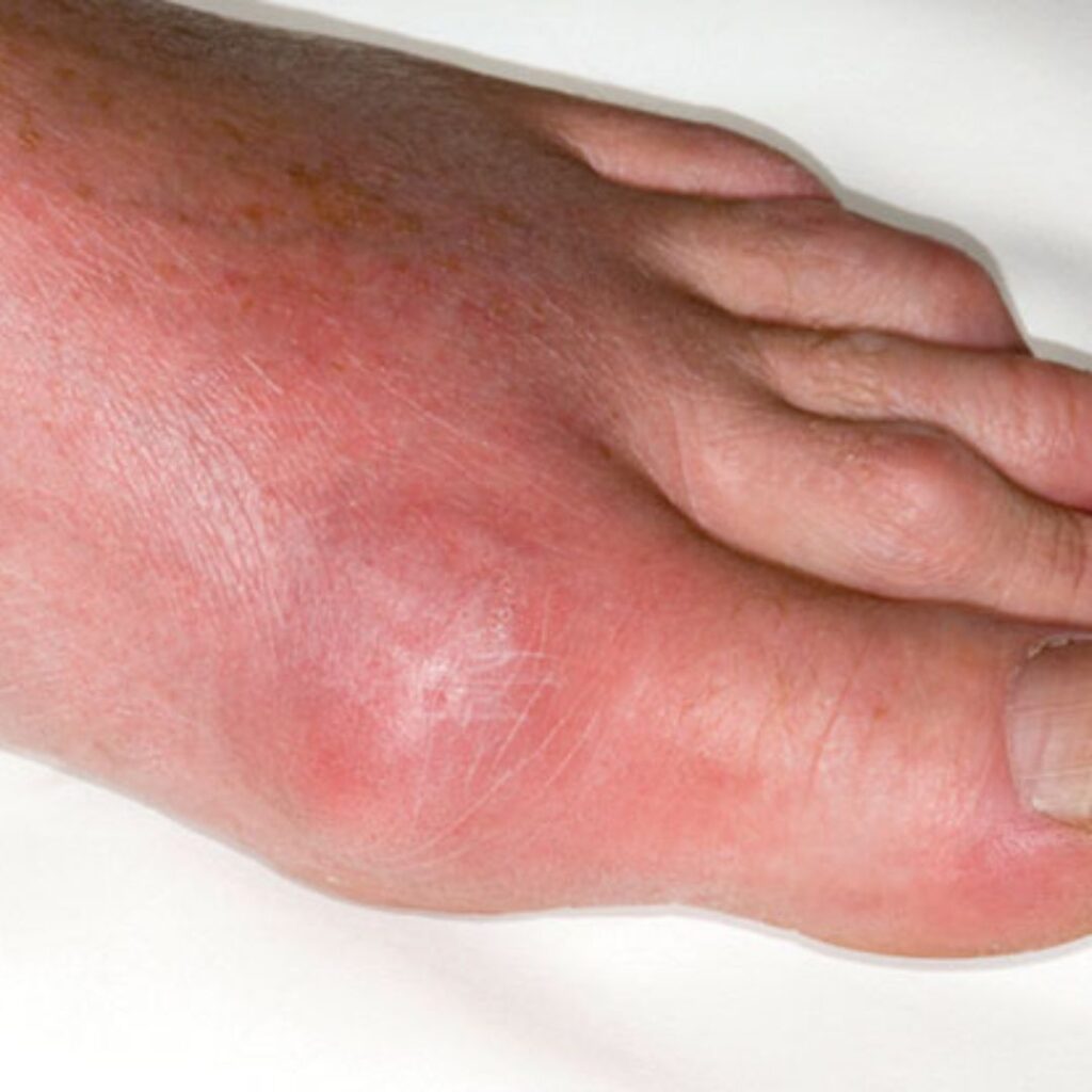 Mild gout flare with joint redness and swelling, a heat-based condition that may respond well to Raktamokshana benefits
