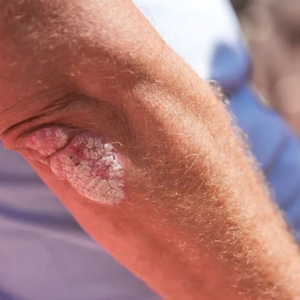 Mild psoriasis and eczema patches with redness and thickened skin, commonly linked to Rakta imbalance treated through Raktamokshana benefits