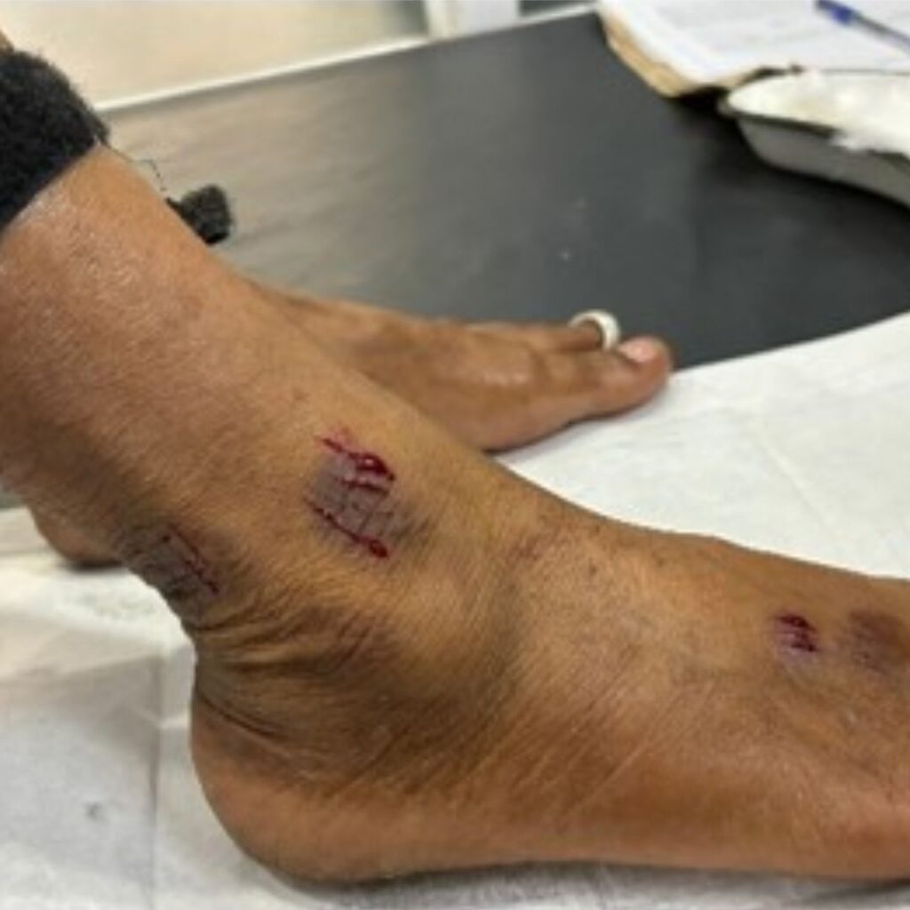 Prachanna superficial scarification technique used in Panchakarma Raktamokshana to release stagnant blood and support raktamokshana benefits