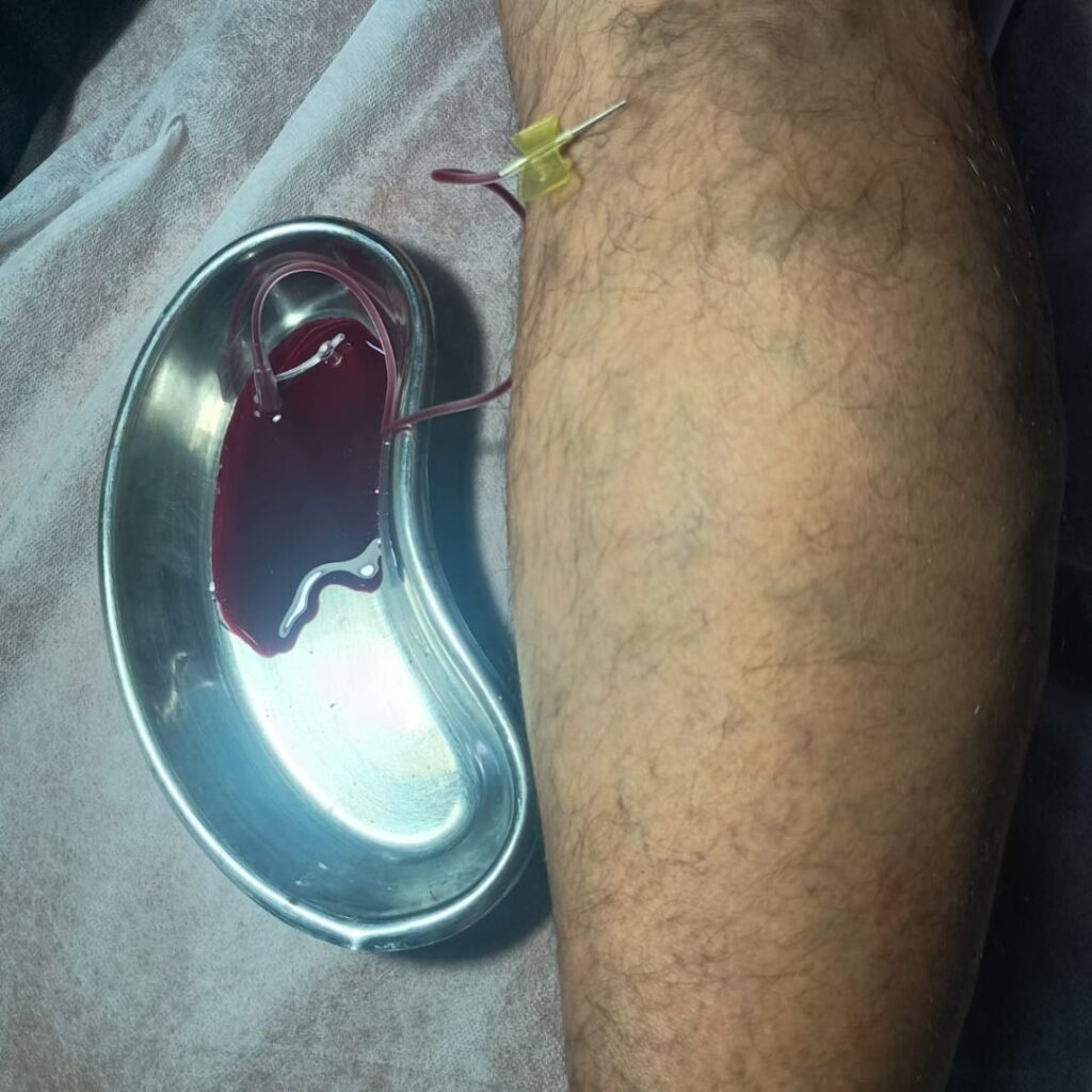 Siravedha procedure performed for varicose veins as part of Panchakarma Raktamokshana to remove vitiated blood and support healthier leg circulation