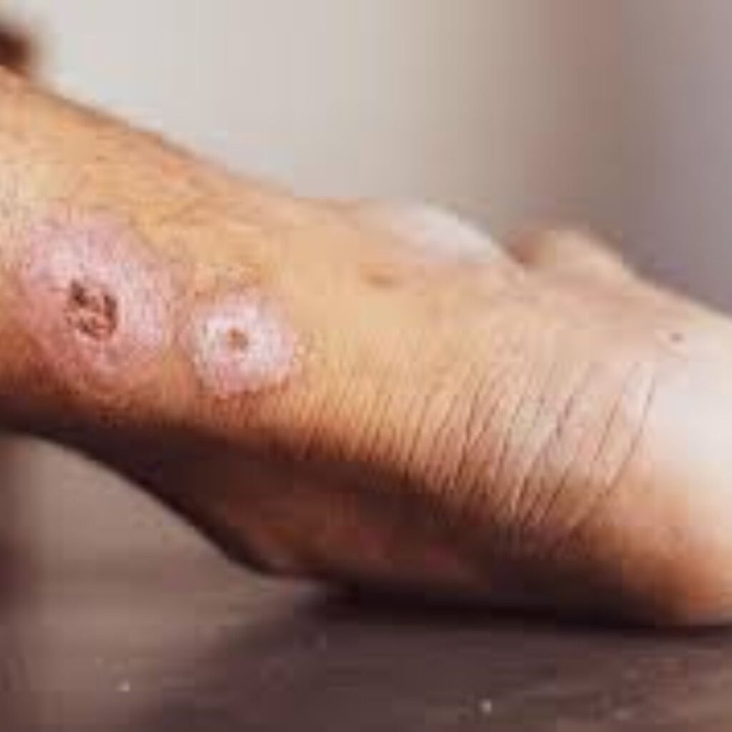 Slow-healing skin area linked to poor peripheral circulation, a condition where improved microcirculation from Raktamokshana is beneficial