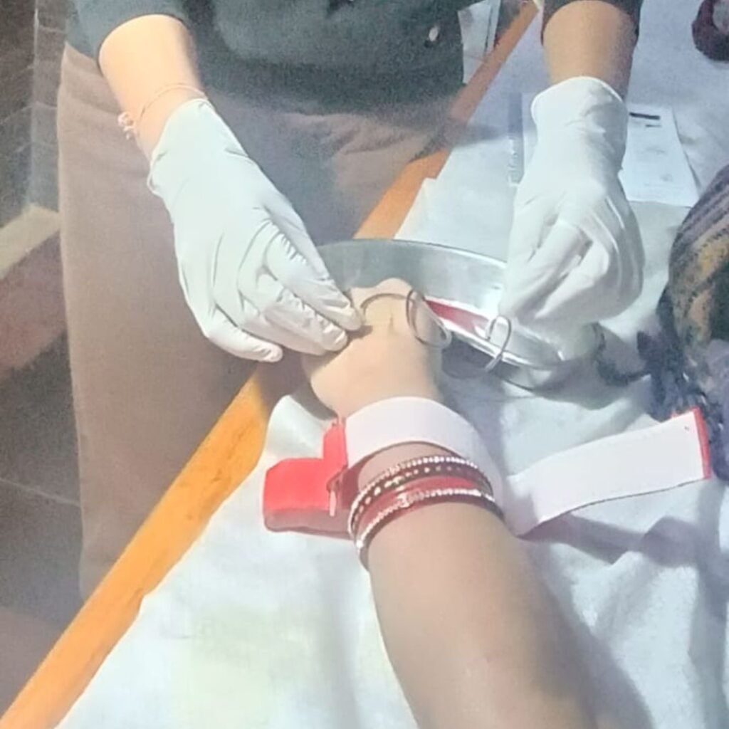 Therapeutic venesection technique supporting raktamokshana benefits in suitable conditions