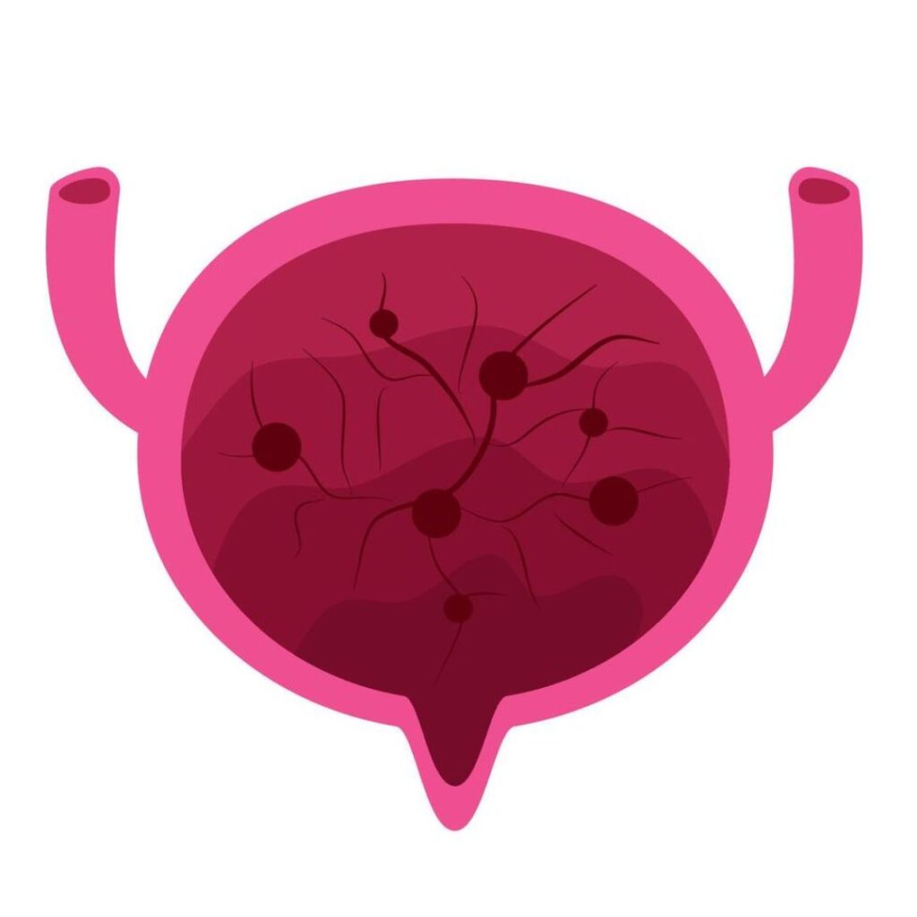 Bladder cysts and inflammation associated with urinary bladder problems