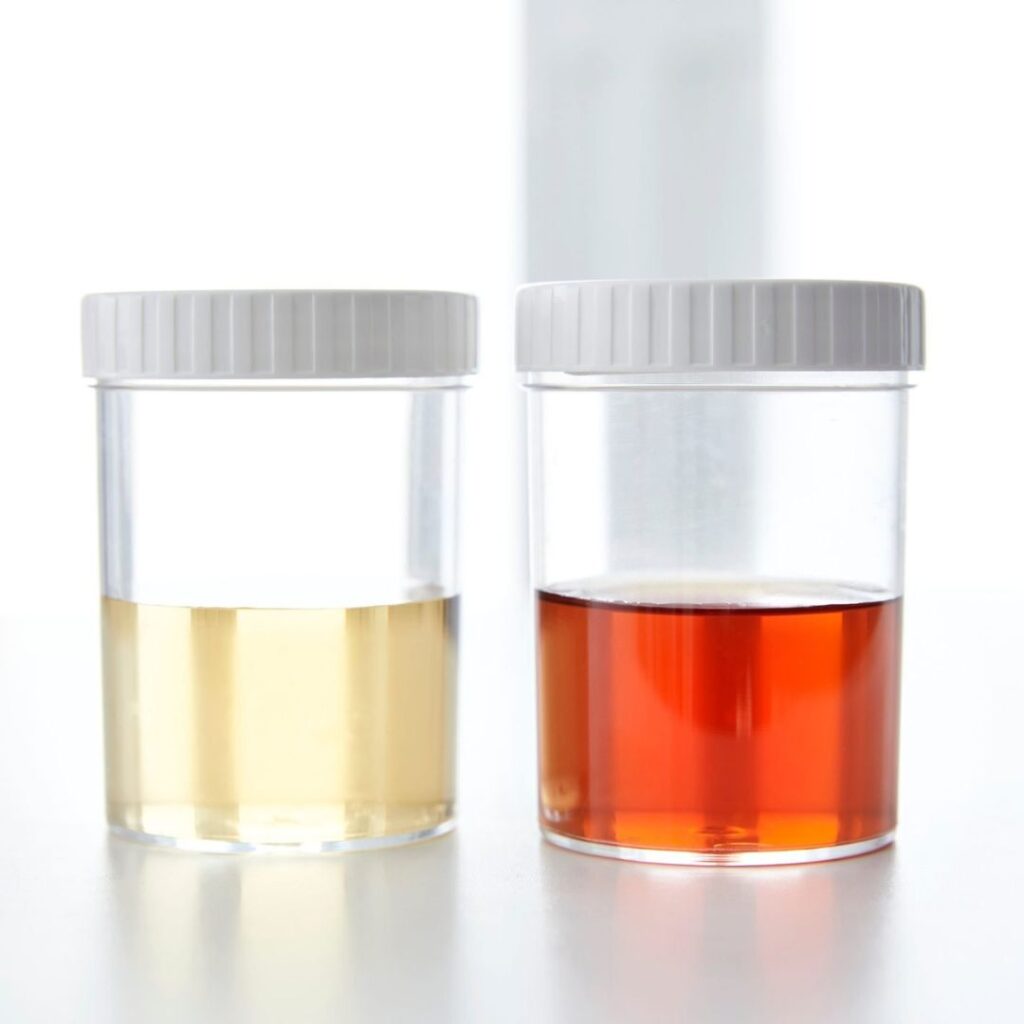 Changes in urine clarity linked to urinary bladder problems