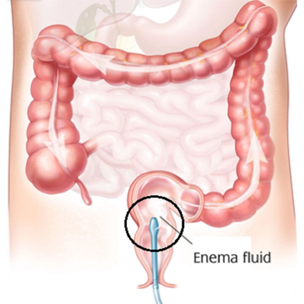 Basti Panchakarma therapy showing medicated fluid administered through the colon