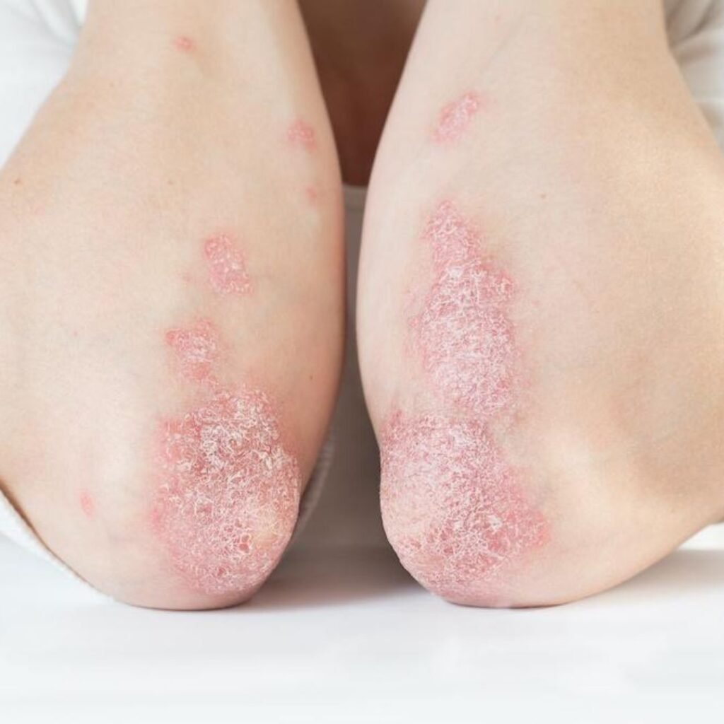 Psoriasis and eczema with skin inflammation, often managed through the benefits of Virechana therapy in Ayurveda
