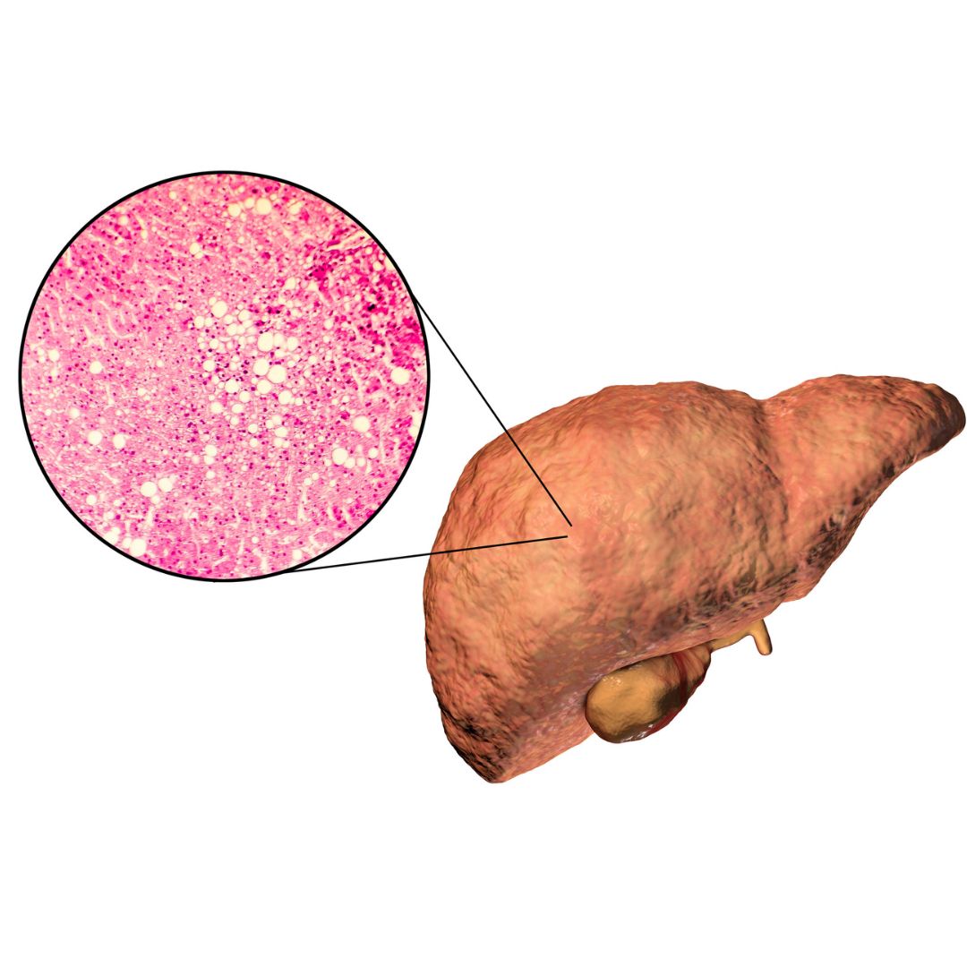 Fatty Liver Disease showing excess fat accumulation in the liver