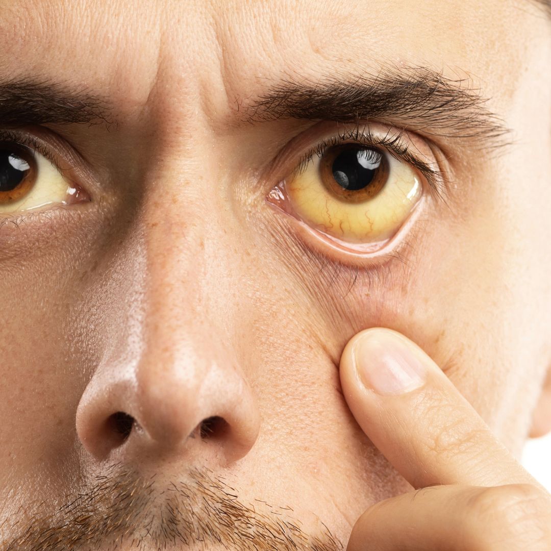 Jaundice caused by elevated bilirubin affecting the liver and bile ducts