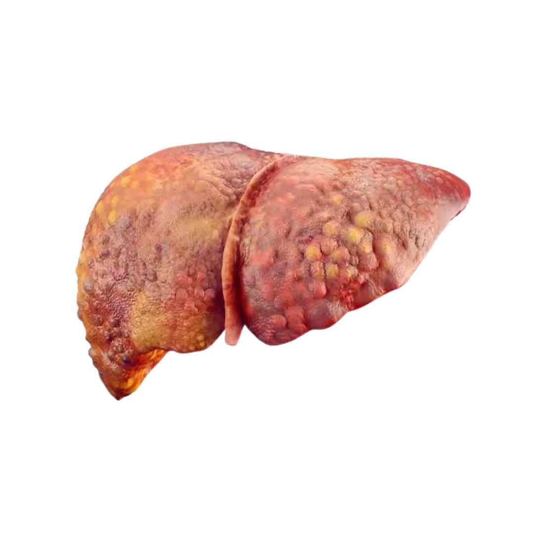Liver Cirrhosis showing progressive scarring of liver tissue