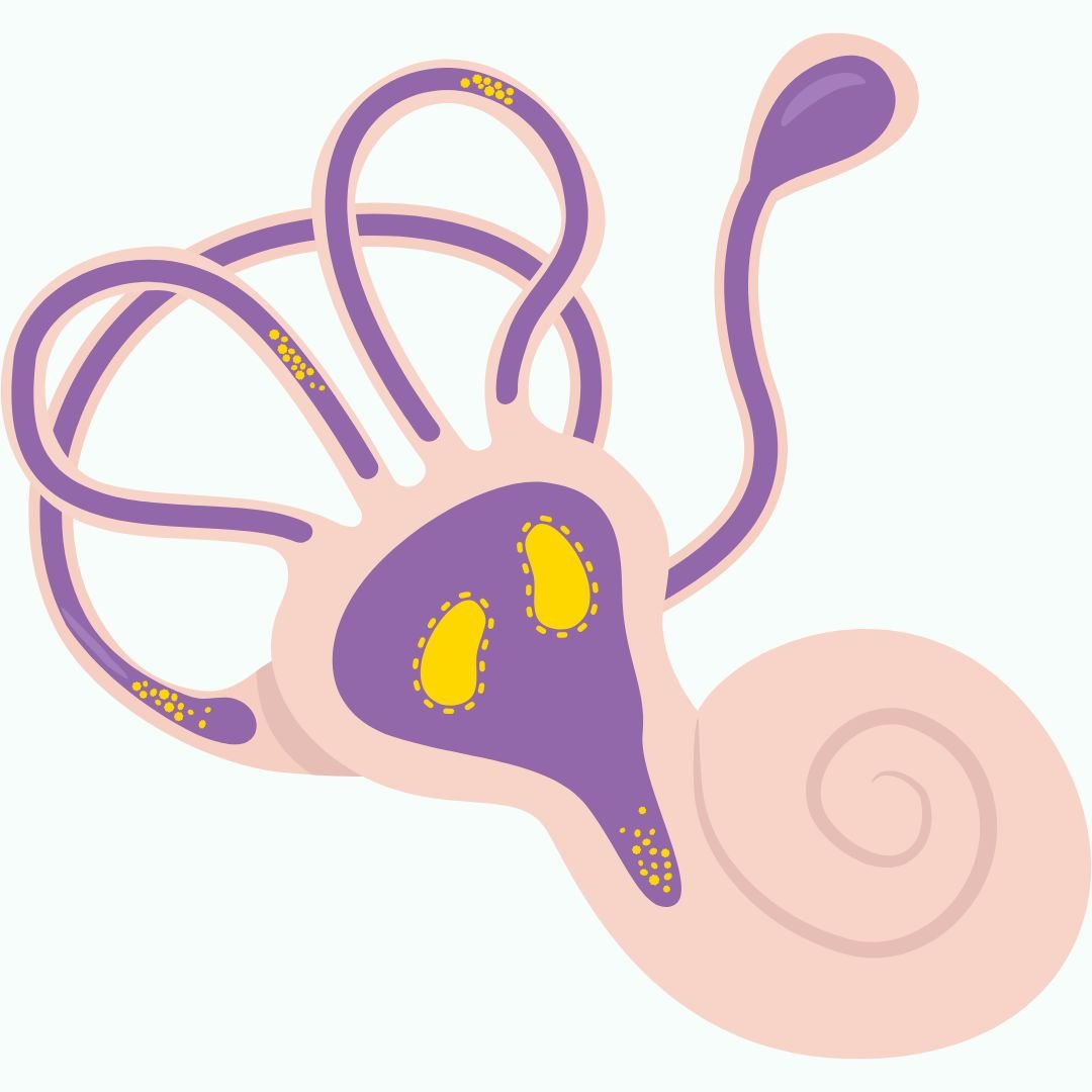 Displaced inner-ear crystals